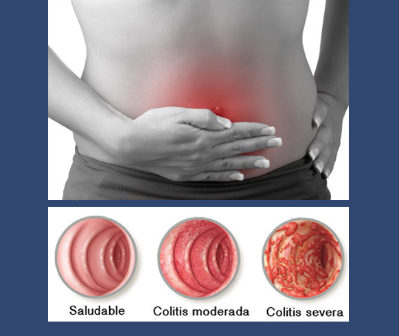 Colitis seudomembranosa - Síntomas y causas - Mayo Clinic